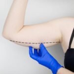 best arm fat reduction treatment