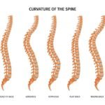 knowing kyphosis