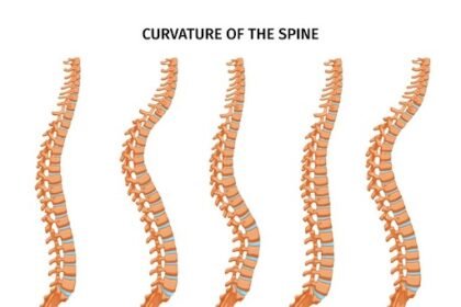 knowing kyphosis